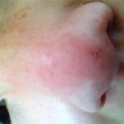 有什么可以去斑