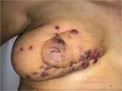 放射后血管肉瘤紫斑图片