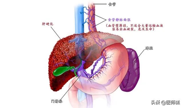 肝硬化前兆有哪些症状？