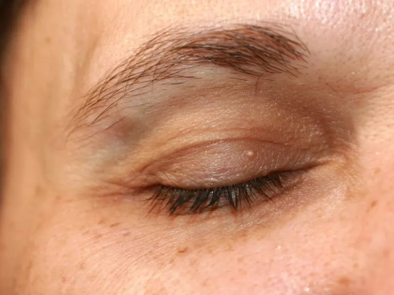 如何去除法令纹