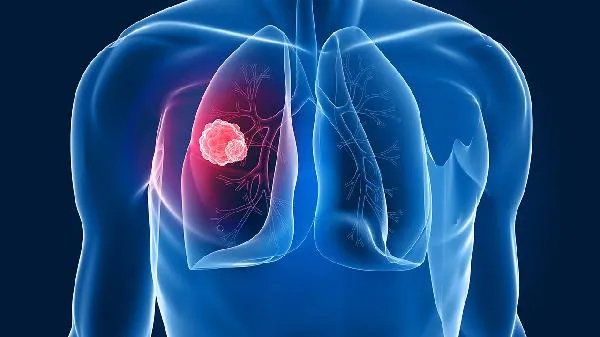 硅肺病和尘肺病的区别