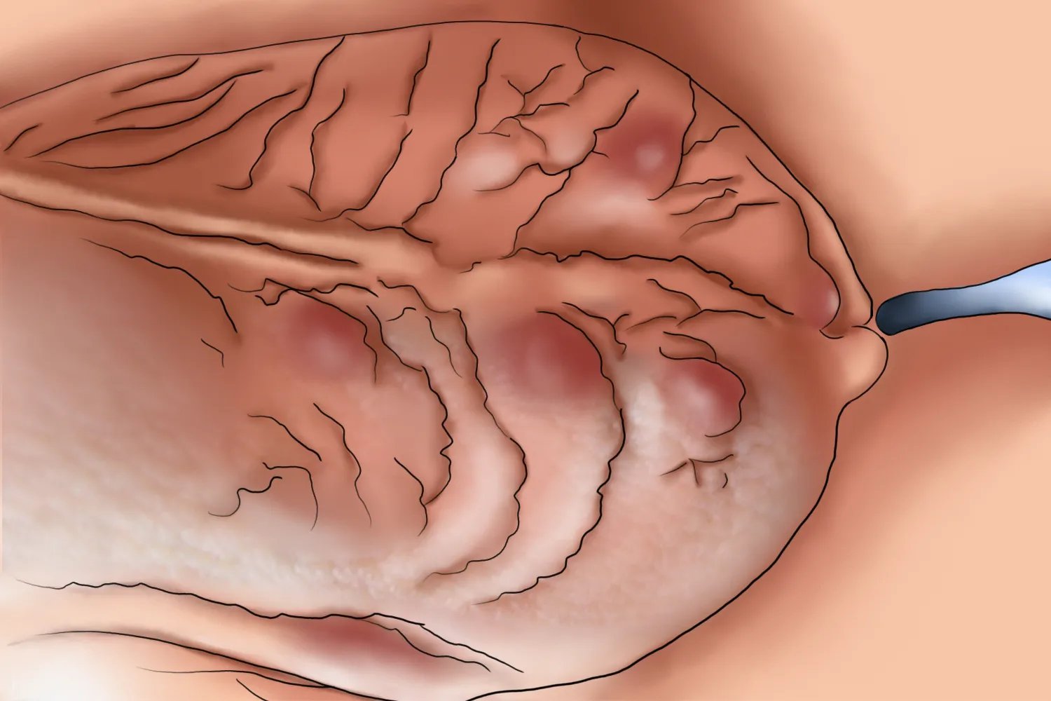 阴囊处疥疮结节图片