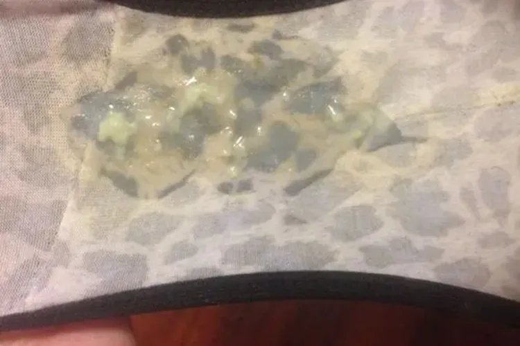 宫颈癌内裤分泌物图片