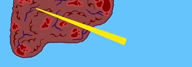 肝硬化前兆有哪些症状？