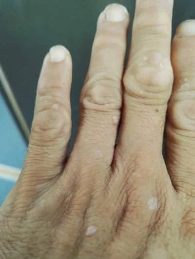 扁平疣最佳治疗方法是什么？