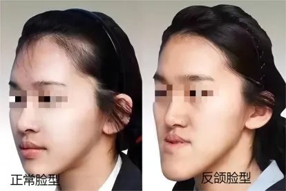 反颌的脸型图片