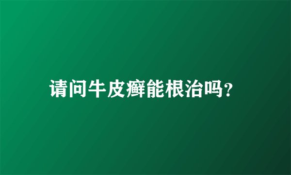 请问牛皮癣能根治吗？