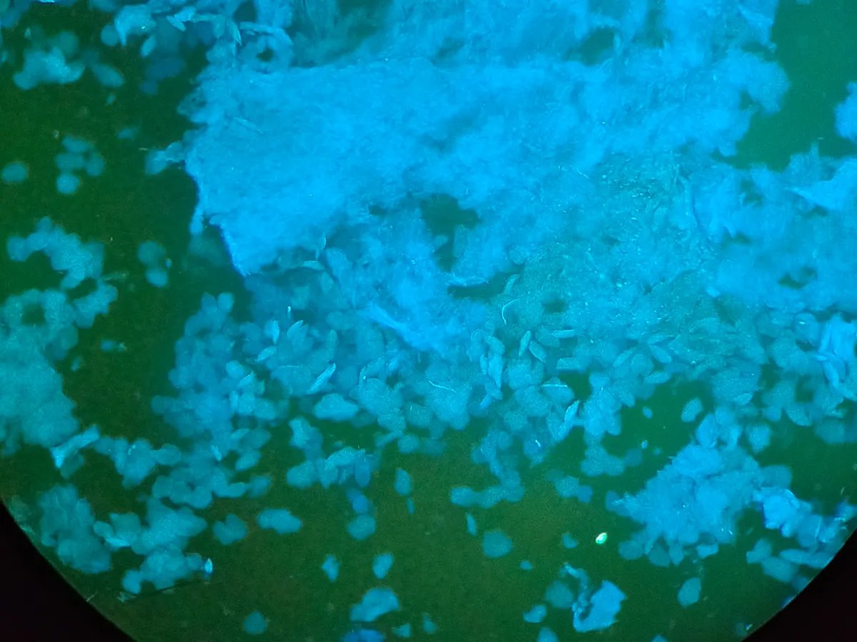 被甲癣困扰10年的张阿姨，经抗菌药物将真菌“打败”