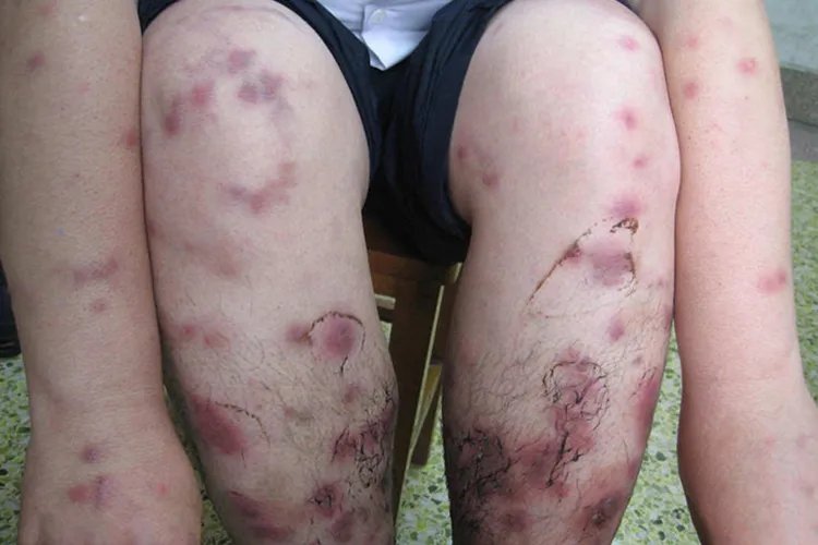 结节性血管炎图片