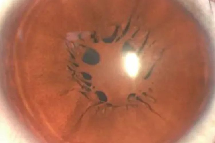 新生儿瞳孔残膜图片