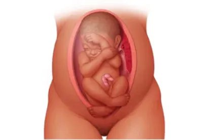 胎位横位真实肚子图片