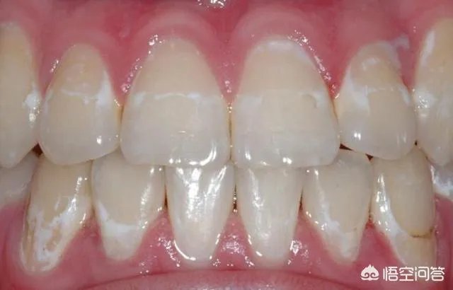 牙釉质发育不良能洗牙吗？