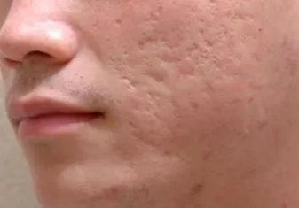 凹陷疤痕怎么办