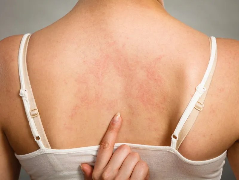 湿疹病因是什么